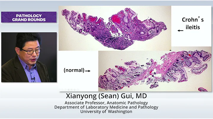 New Concepts in IBD Pathology