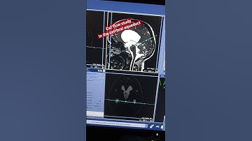 Mri csf flow Study #mri csf flow cerebral aqueduct