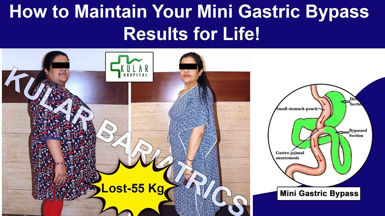 How to Maintain Your Mini Gastric Bypass Results for Life! @kskular ...