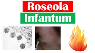 Roseola Infantum (Sixth Disease) | Symptoms (Fever & Rash in Infants), Diagnosis, Treatment