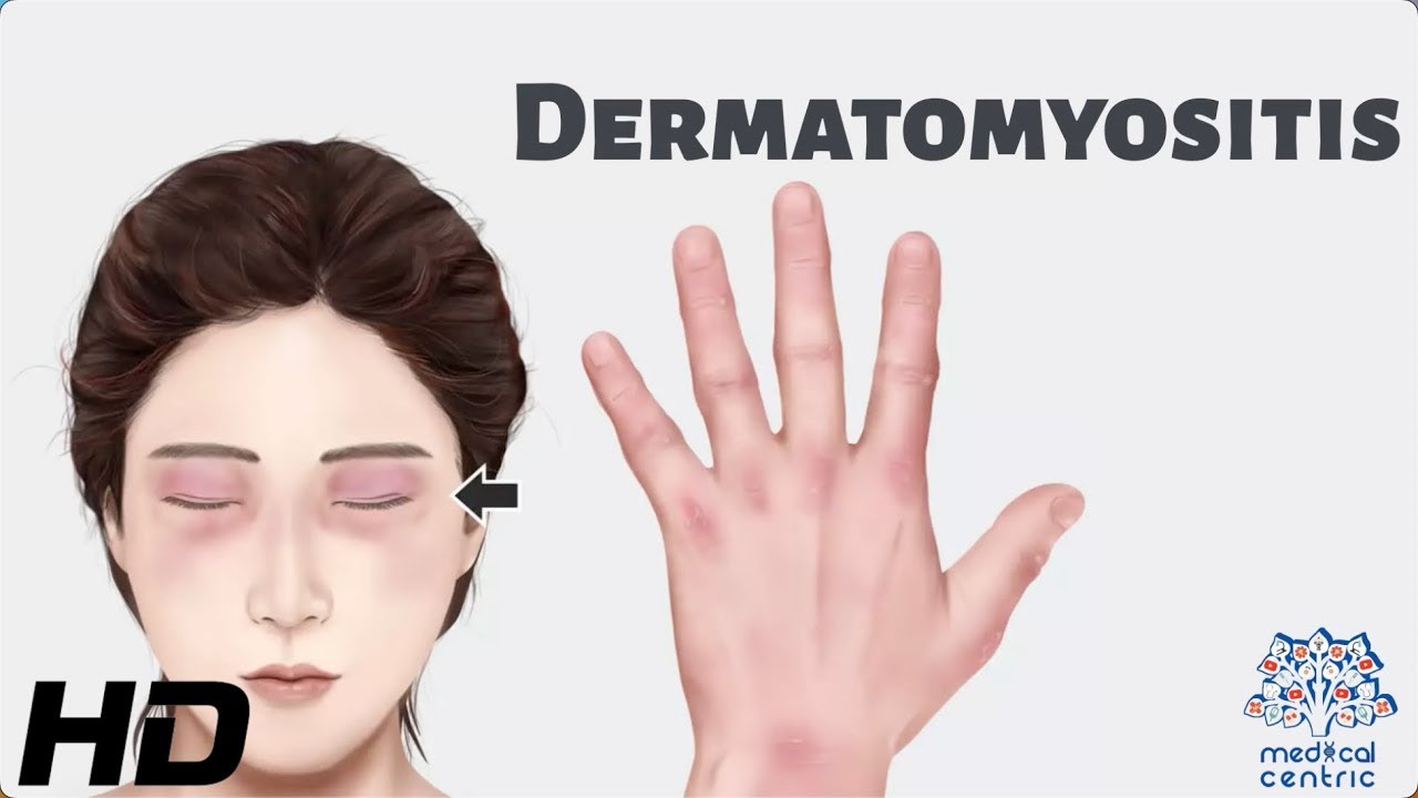 Dermatomyositis Everything You Need To Know YouTube Dermatomyositis Everything You Need To Know YouTube
