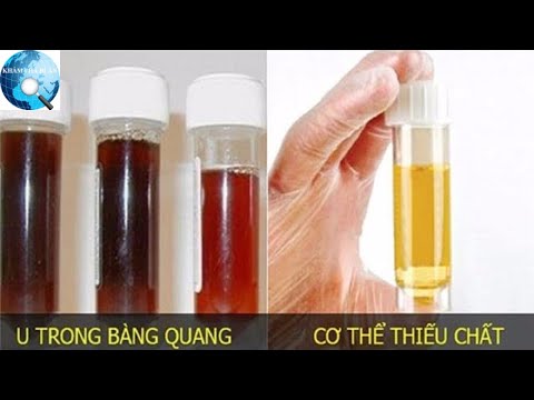 Nước Tiểu Màu Đỏ Nhạt Ở Nữ - Màu sắc của nước tiểu cảnh báo tình trạng sức khỏe của bạn