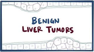 Benign liver tumors  causes, symptoms, diagnosis, treatment & pathology