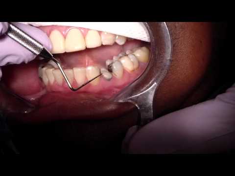 Attached Gingiva - A Few Ways To Measure..