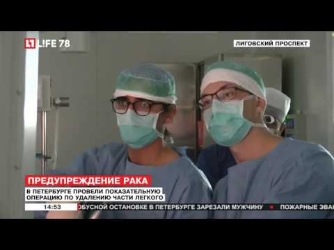 Complex uniportal VATS anatomic segmentectomy (LIFE 8 TV Russian news)