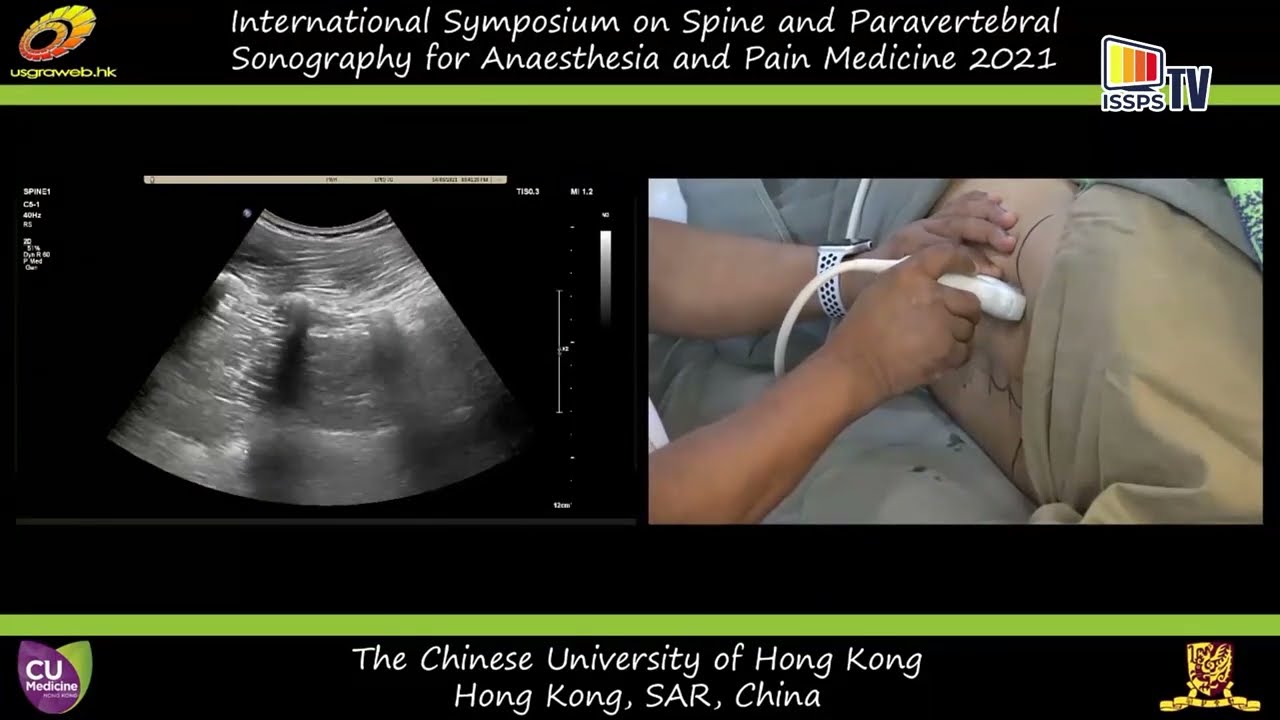Ultrasound Imaging of the Lumbar Spine: Sonoanatomy Demonstration in Volunteers. Dr. M.K. Karmakar