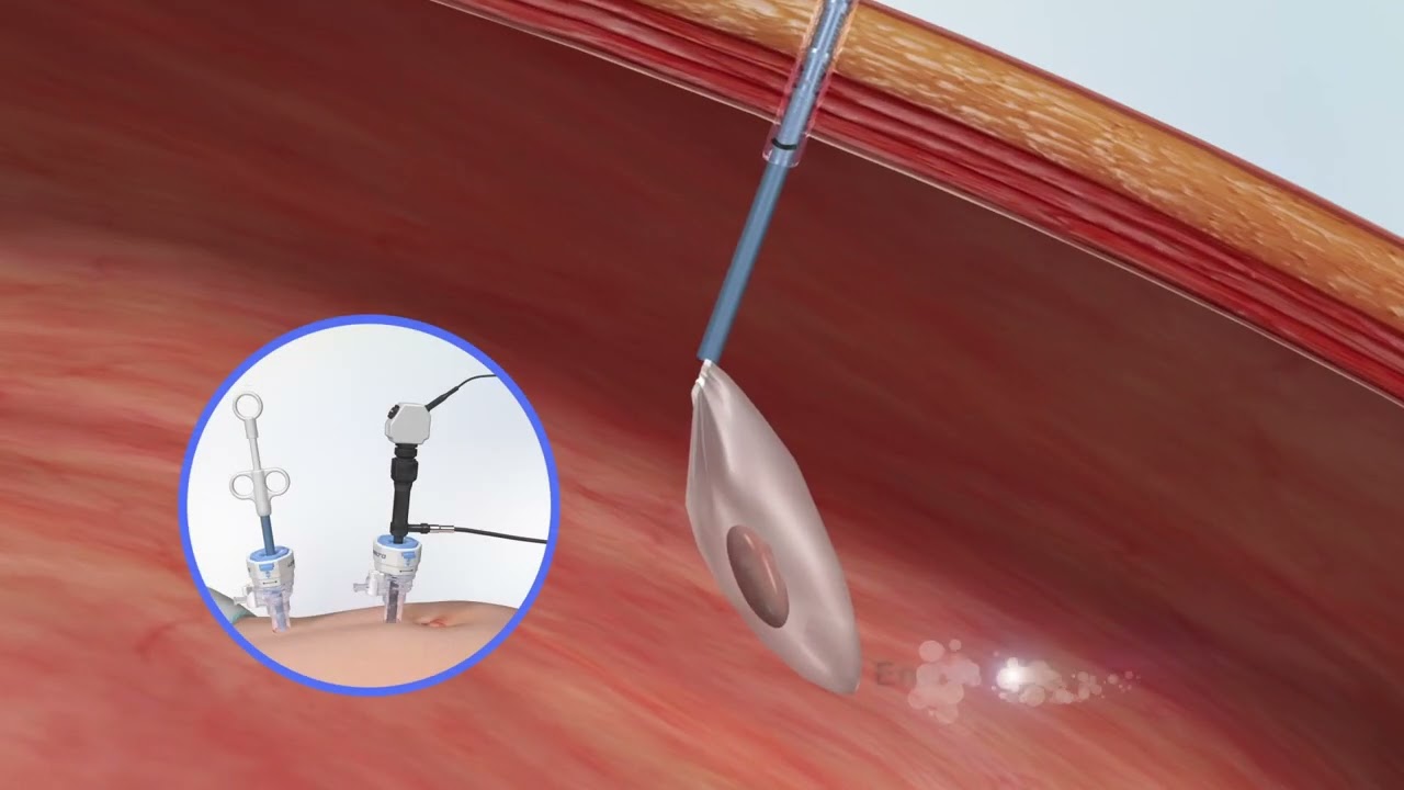 Unimicro Disposable Retrieval Pouch for Laparoscopic Surgery