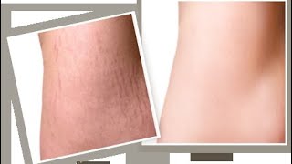 افضل وصفات وعلاج لعلامات تمدد الجلد Stretch marks