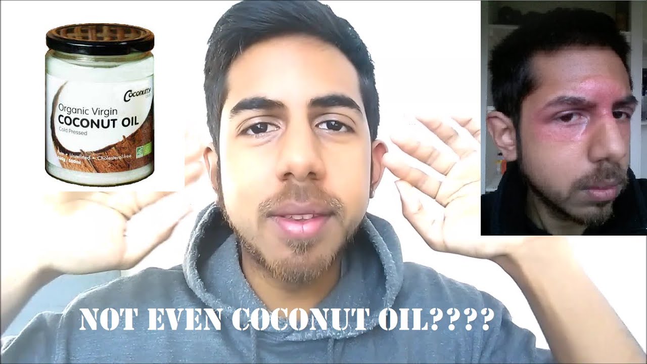 Why I don't recommend Coconut Oil for Eczema