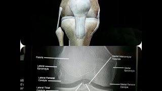 Normal Knee Joint X-Ray with 3D Anatomy