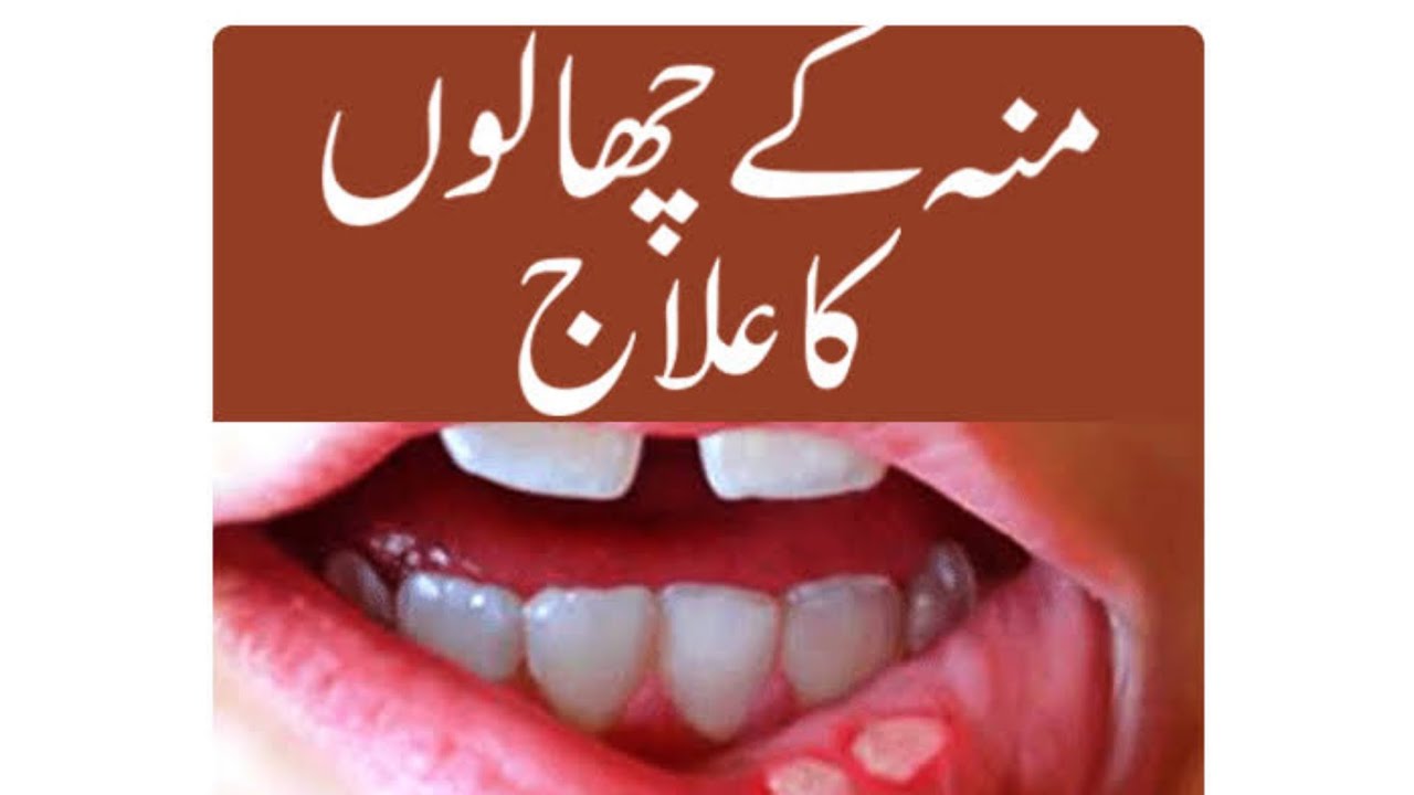 how to cure mouth ulcer or blisters (mun k Chalon ka ilaj ) mouthulcer homoeopathictreatment