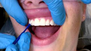 Tips For Applying Fluoride Varnish screenshot 4