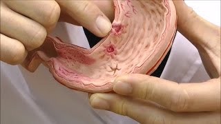 胃潰瘍モデル：動画