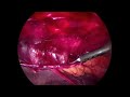 TAPP repair for symptomatic small umbilical hernia