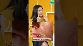UV Rays & Sun Damage: Tanning, Pigmentation & Collagen Loss | Curly Tales #shorts