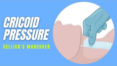 Cricoid pressure | Technique