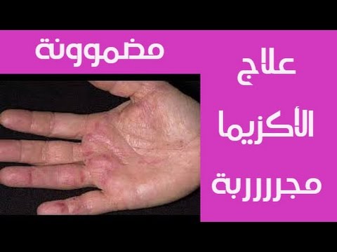 أسرع طريقة لعلاج الاكزيما بجميع انواعها مجربة و مضمونة | علاج الاكزيما