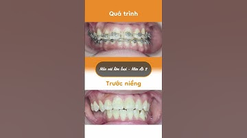 Hành trình LỘT XÁC nhờ niềng răng của Mỹ Phương