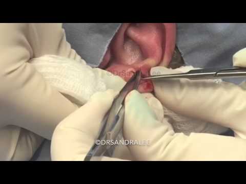 Ear Cyst POPPED. For Medical Education- NSFE.