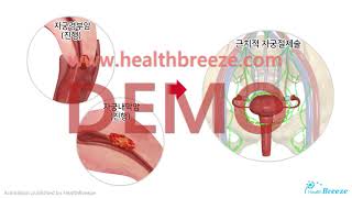 [시연용] c0030abko_[축약판] 근치적자궁절제술 및 골반림프절절제술 안내