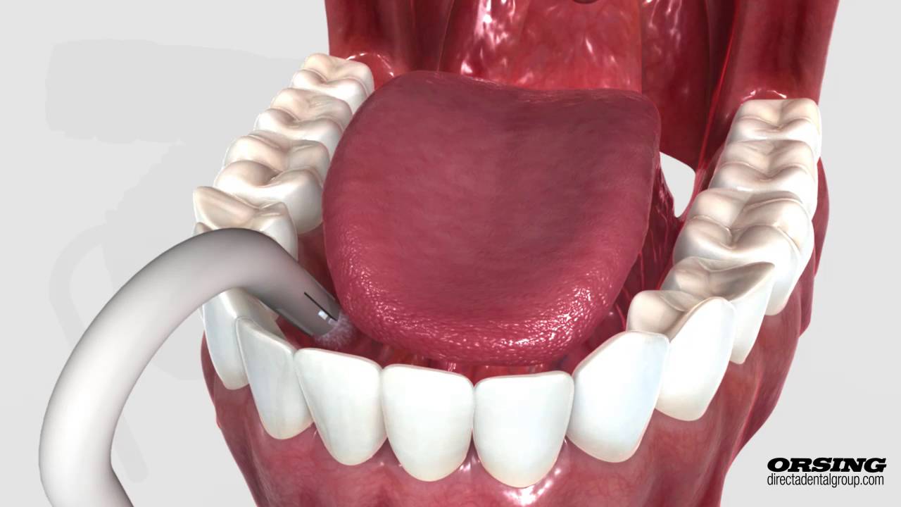 Hygoformic®, Hygofix®, Aspirator Tubes & Hygosurge® by Orsing