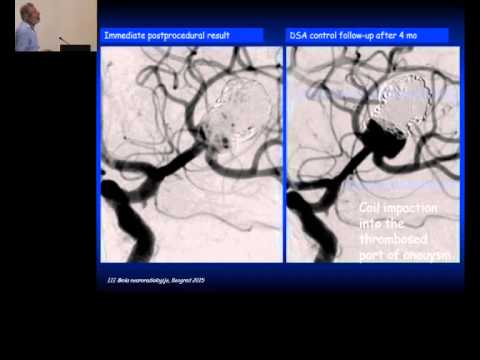 Napredne tehnike endovaskularnog tretmana IA, Branko Prstojevic 3_07