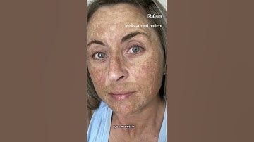 Melasma Can Be Cured With Hydroquinone: Dermatologist Explains!