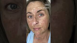 Melasma Can Be Cured With Hydroquinone: Dermatologist Explains!