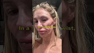 Something is Eating Her Face! Brandi Glanville's Terrifying Health Battle
