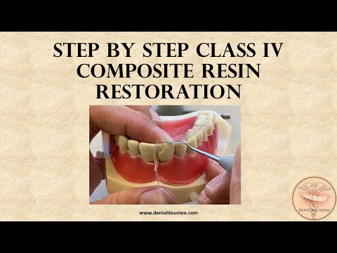 STEP BY STEP - Class IV dental restoration with composite