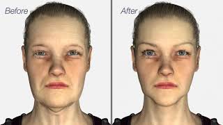 Facelift & Neck Lift surgery - Dr. Julian De Silva - 3D medical animation