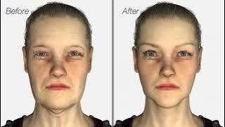 Facelift & Neck Lift surgery - Dr. Julian De Silva - 3D medical animation