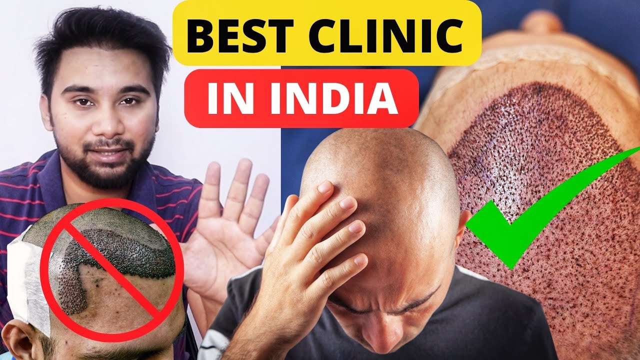 5 Indications Of A Bad Hair Transplant Result How To Choose Best Hair