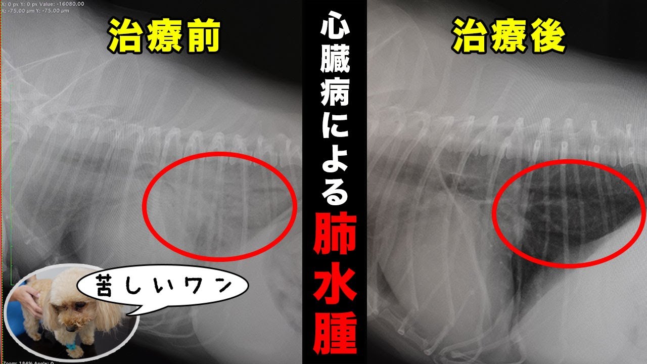 僧帽弁閉鎖不全症による肺水腫