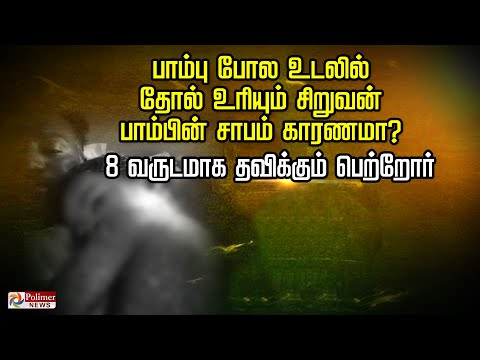 பாம்பு போல உடலில் தோல் உரியும் சிறுவன்..! பாம்பின் சாபம் காரணமா? 8 வருடமாக தவிக்கும் பெற்றோர்