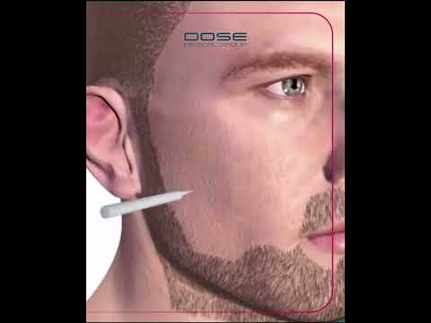 زراعة شعر اللحية خطوة بخطوة في تركيا         