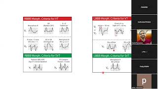 D Amr Yousry wide complex tachycardia 2.mp4