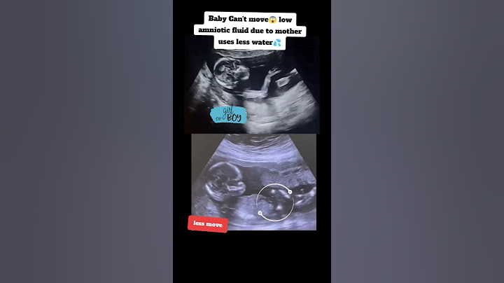 Baby can't move😱low amniotic fluid mother uses less water|#pregnancy #ultrasound #baby