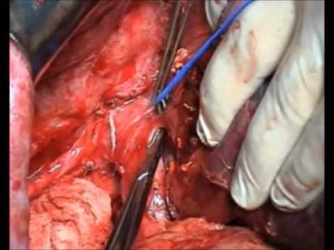 Right hepatic trisectionectomy after portal vein ligation