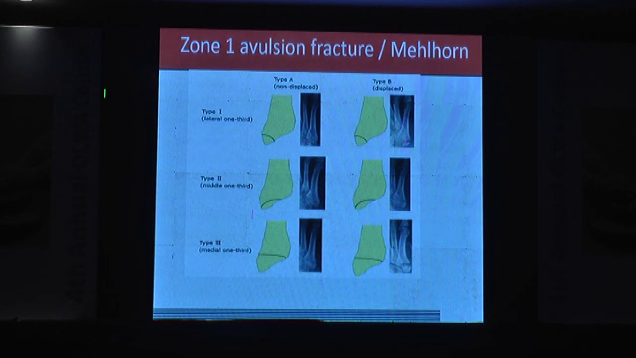Jones fracture, Dr Balvinder Rana, Olwa Foot & Ankle Course - YouTube