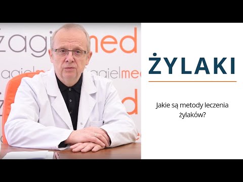 Wideo: 3 sposoby na złagodzenie bólu żylaków