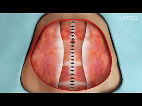 Video: Abdominoplastia Abdomenului - Recenzii, înainte și După