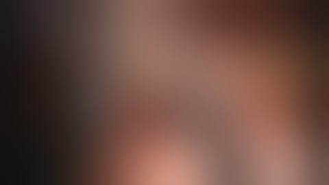 Robotic Single-Site Cholecystectomy (HD) K M Konstantinidis, MD,PhD,FACS