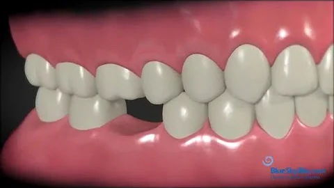 The Benefits of Dental Implants: Why You Should Replace a Missing Tooth