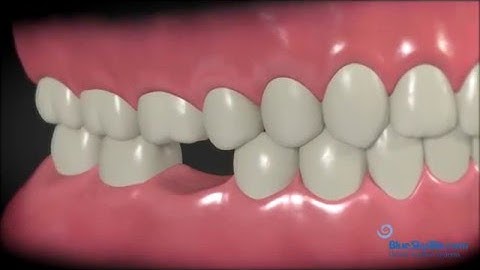 The Benefits of Dental Implants: Why You Should Replace a Missing Tooth