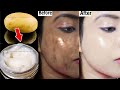 1 Day Challenge - Dark Skin Gone | Remove Hyperpigmentation From Face