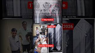 Next Day Of Surgery:- Femur Bone fracture of Mr. Madhuvan 19 May 2026