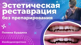 Убираем щербинку на режущем крае | Эстетическая реставрация