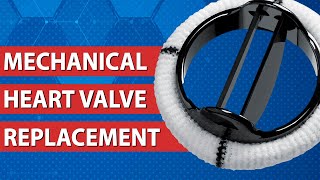 Mechanical Heart Valve Replacements: An Introduction with Dr. Aqeel Sandhu