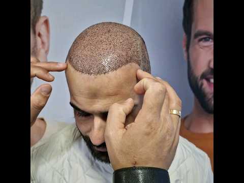 الحصول على شعر طبيعي مع زراعة الشعر